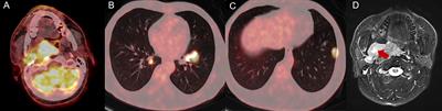 Case Report: Immunotherapy for low-grade myofibroblastic sarcoma of the pharynx